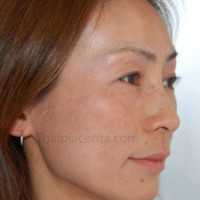 พลาเซนต้าช่วยให้ผิวขาวขึ้น